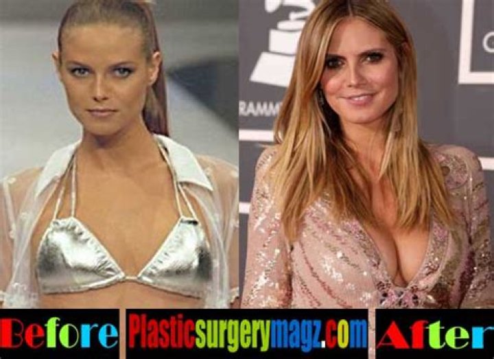 Heidi Klum Breast Implants 2024: The Truth Behind the Rumors